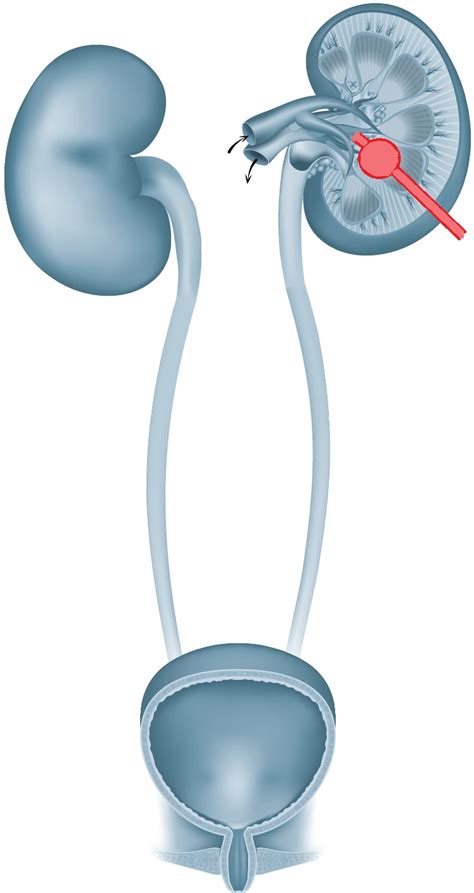 nierenkatheter|Klinik und Poliklinik für Urologie: Nierenfistelkatheter